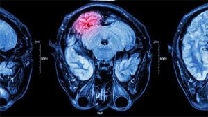 daño cerebral por consumo de cocaína