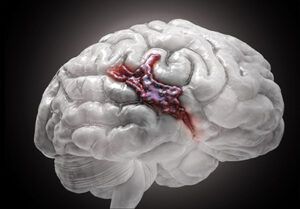 hemorragia cerebral por consumo de cocaína