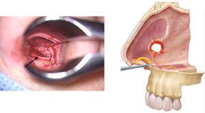 perforación del tabique nasal por cocaina