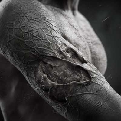 lesiones cutáneas krokodil